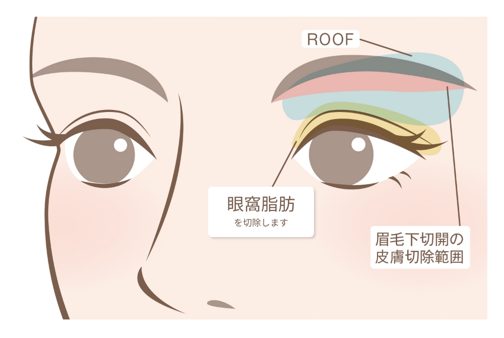 眼窩脂肪切除